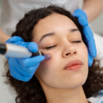 Rejuvenate Your Skin with Microneedling with PRP Near Me