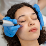 Top Benefits of Microneedling Treatment for Skin Rejuvenation