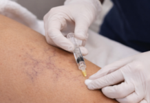 Restore Your Legs: How Sclerotherapy Vein Treatment Transforms Your Confidence and Appearance