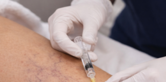Restore Your Legs: How Sclerotherapy Vein Treatment Transforms Your Confidence and Appearance